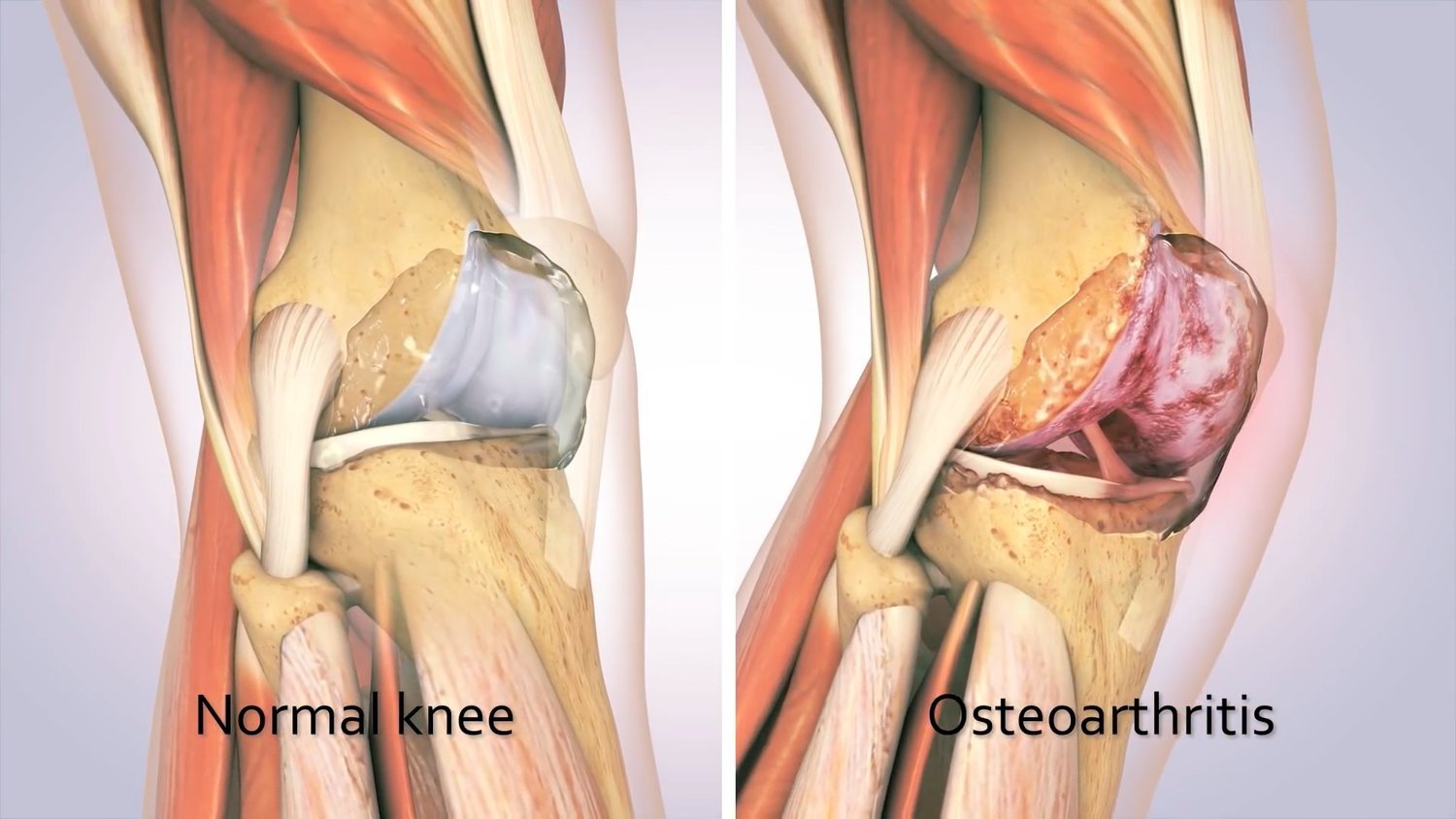 artroza articulației genunchiului artroza este posibilă restaurarea articulației