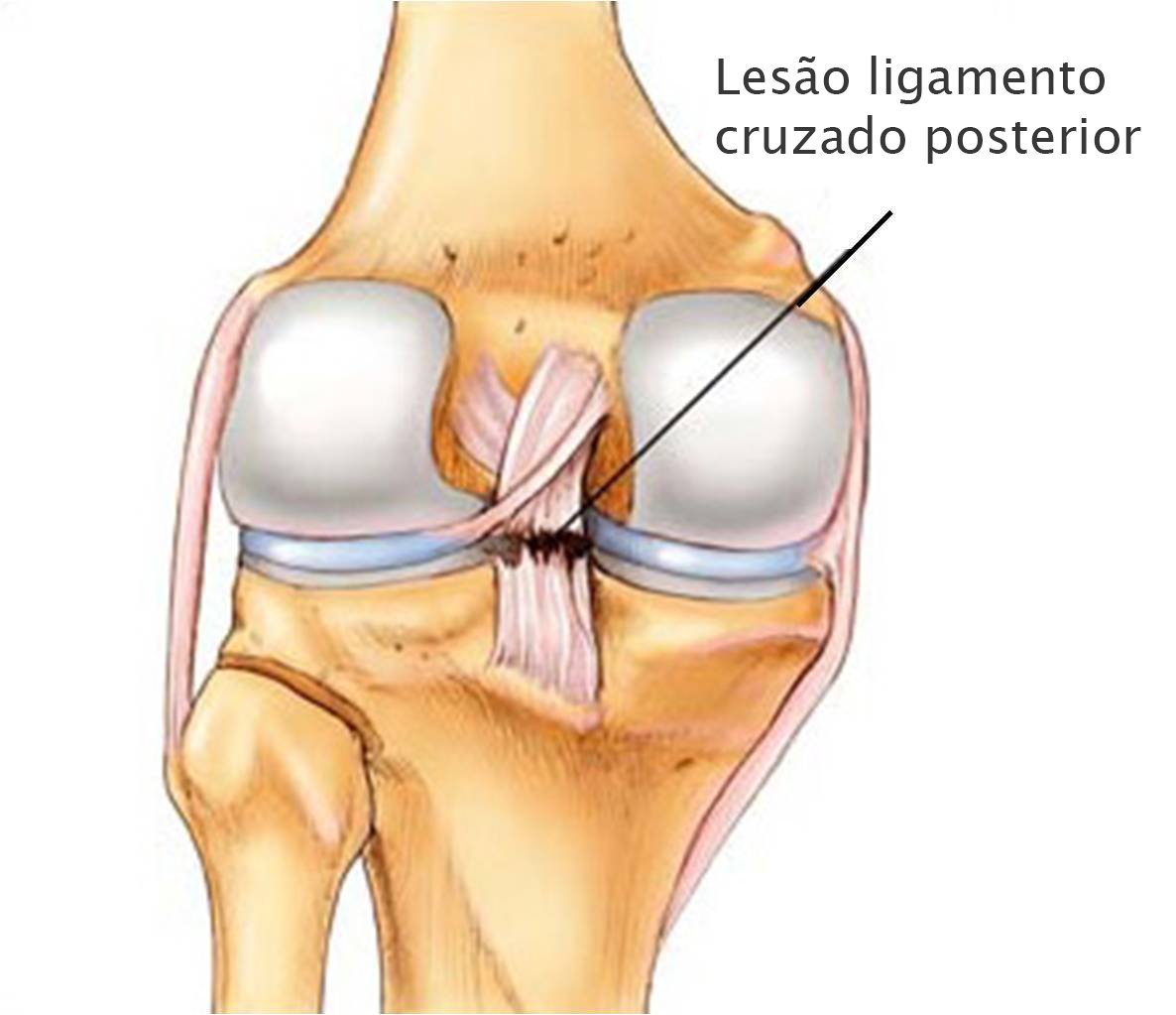 A lesão do ligamento cruzado anterior é uma ruptura no ligamento.