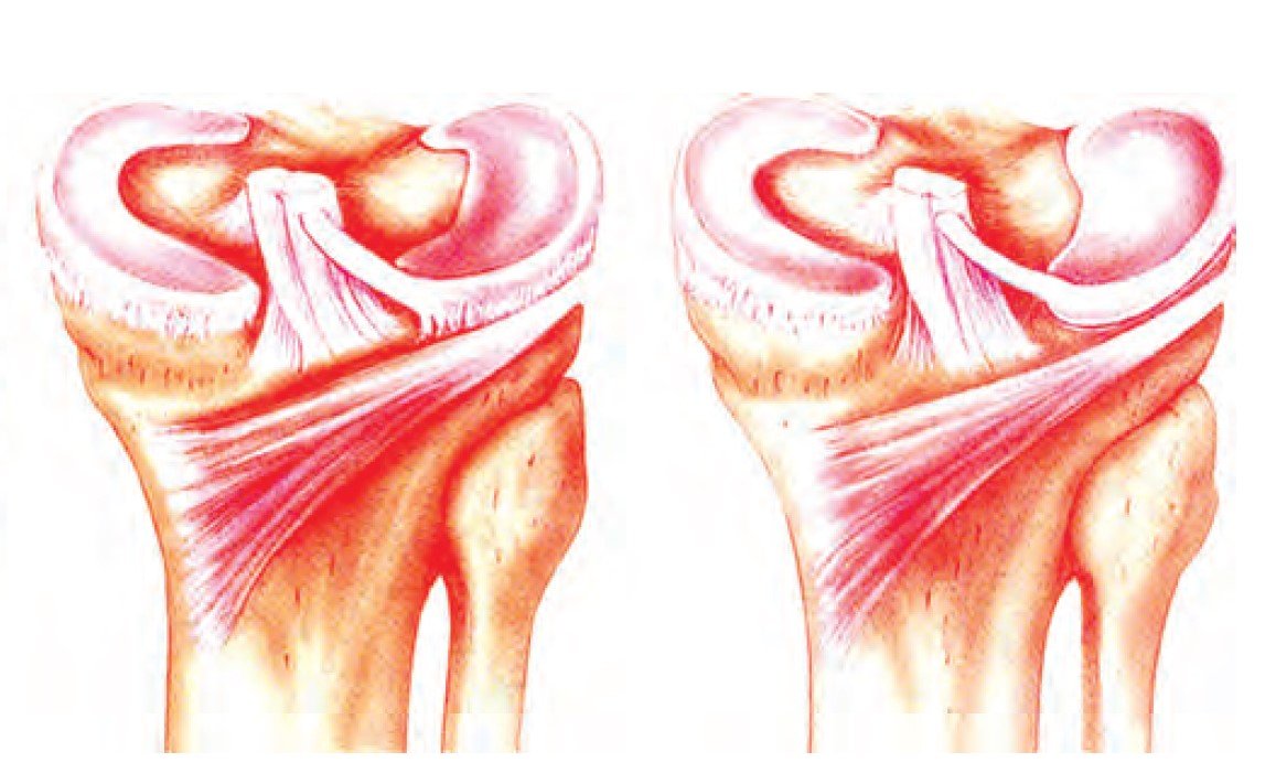 Meniscos são estruturas fibrocartilaginosas localizadas no centro da articulação dos joelhos.