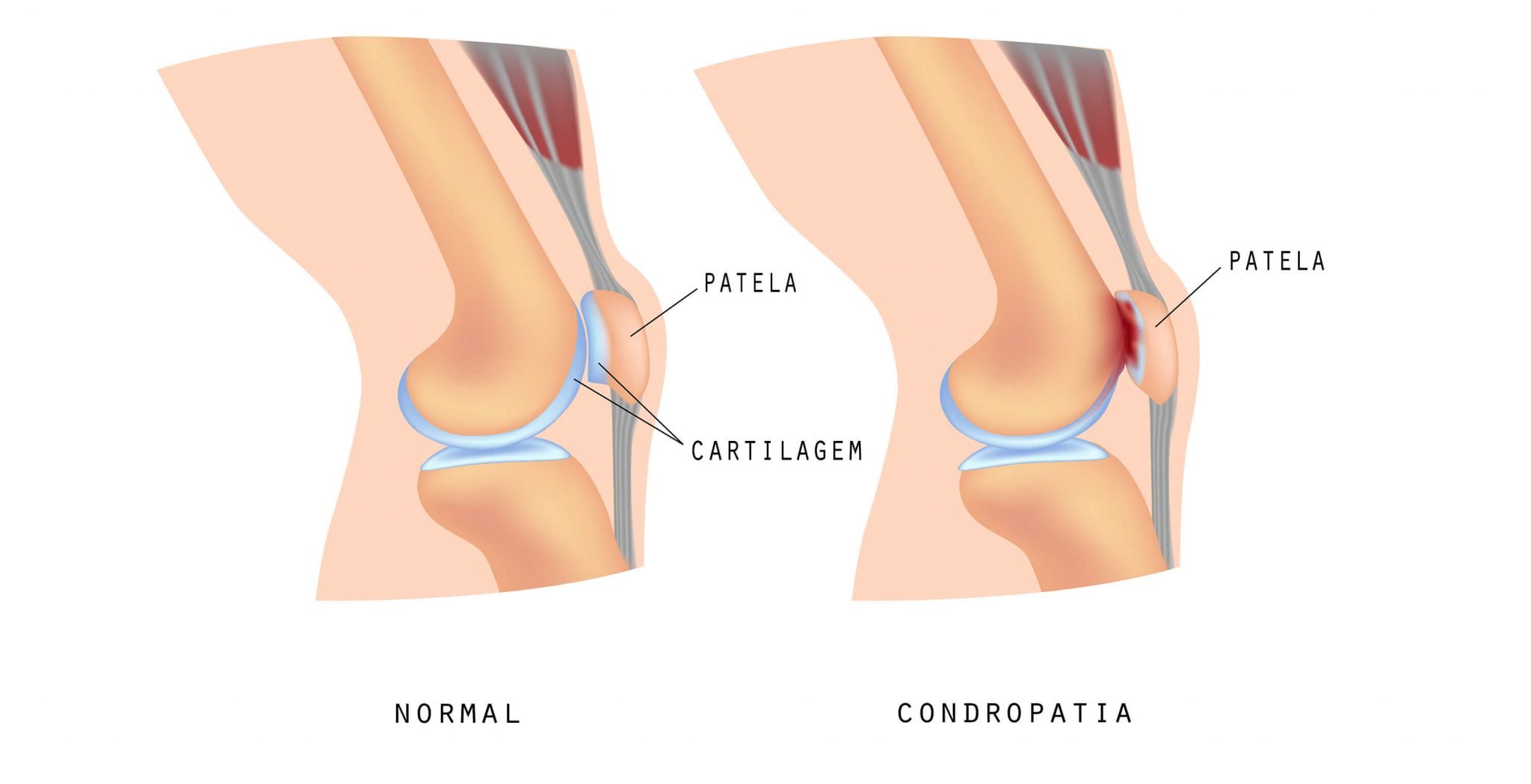 Condromalácia Patelar: estrutura do joelho