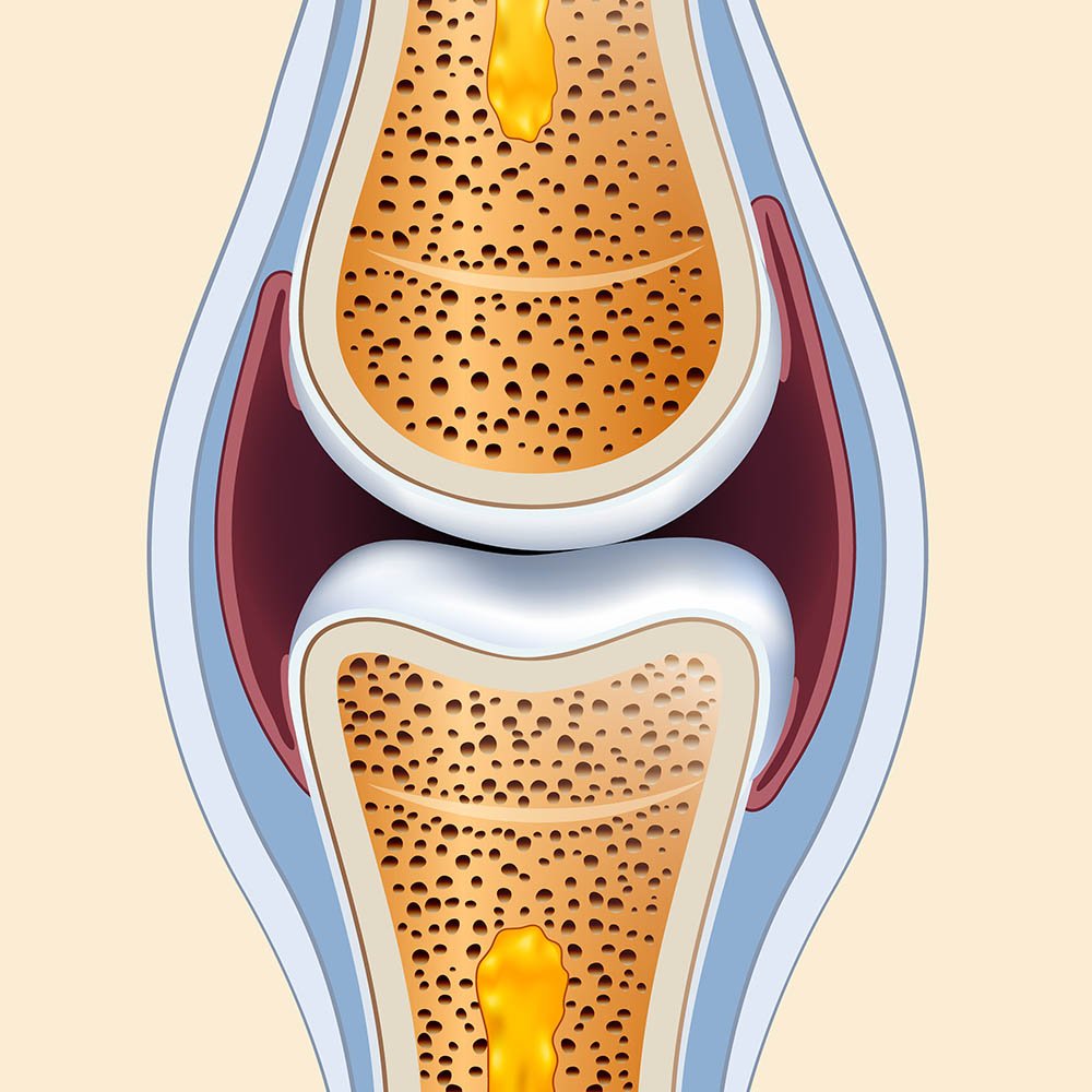 tipos de artrite: Osteoartrite ou artrite degenerativa